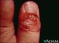 herpes finger