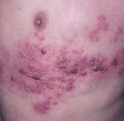zoster virus