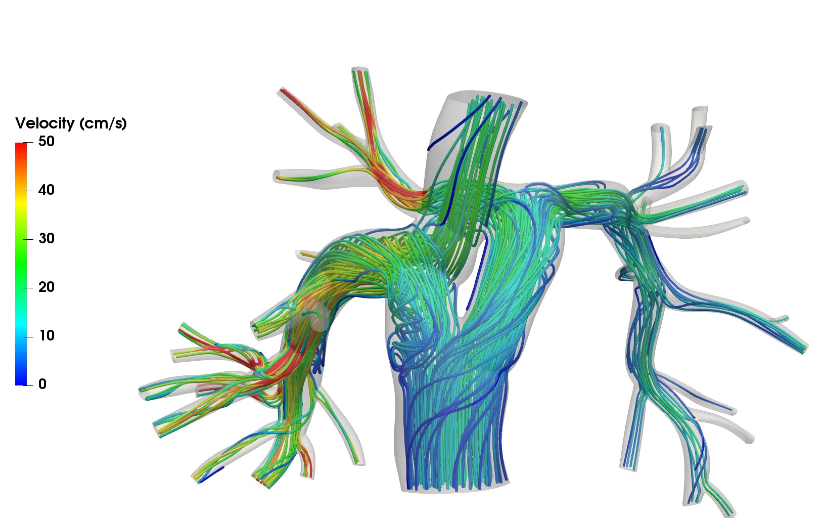 Y-shaped Fontan Graft